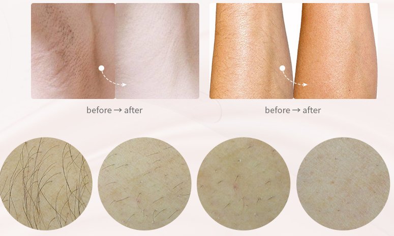 Tác dụng của máy triệt lông cầm tay mini mlay t3